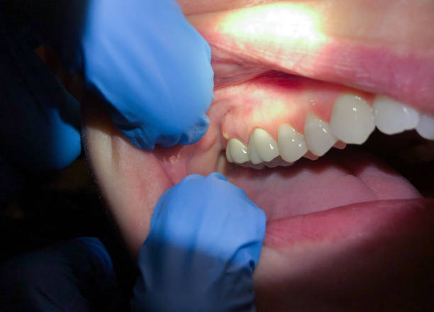 Best Chipped Tooth Repair Near Me  in Greensburg, IN